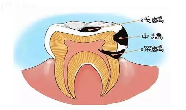 龋齿形成原因是什么，多久会烂到神经，治疗方法有哪些？