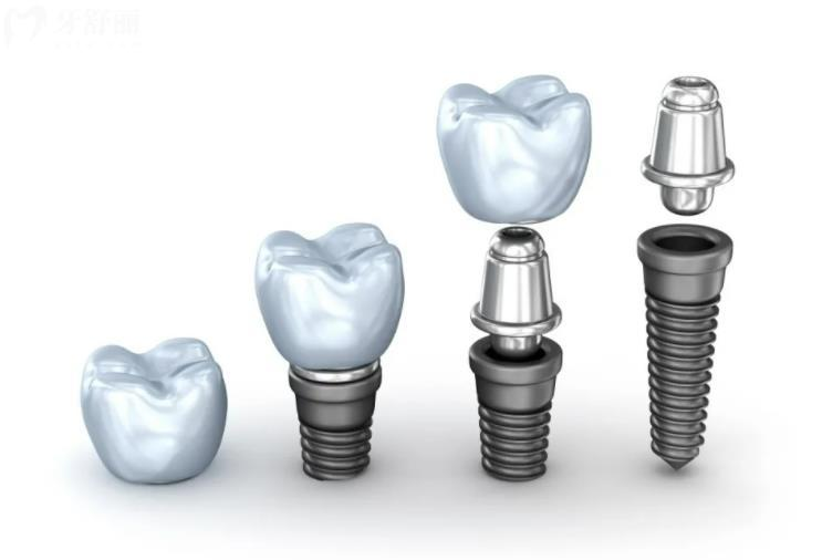 种植牙修复步骤曝光，做好这几步保护好你的牙！