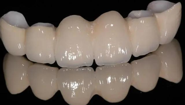 烤瓷牙和全瓷牙哪个好？有什么区别吗？哪个寿命长？