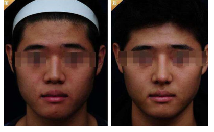 做鼻头缩小治疗效果怎么样？效果保持时间多久？